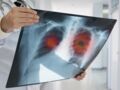 Cancer du poumon : causes, symptômes, traitements et guérison
