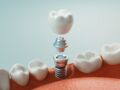 Implant dentaire : déroulement et étapes de la pose, prix, cicatrisation