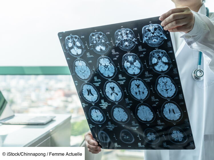 Encéphalite : symptômes, traitement, séquelles de cette inflammation ...