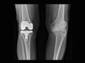 Arthroplastie : genou, épaule, hanche... ce qu'il faut savoir sur cette opération des articulations