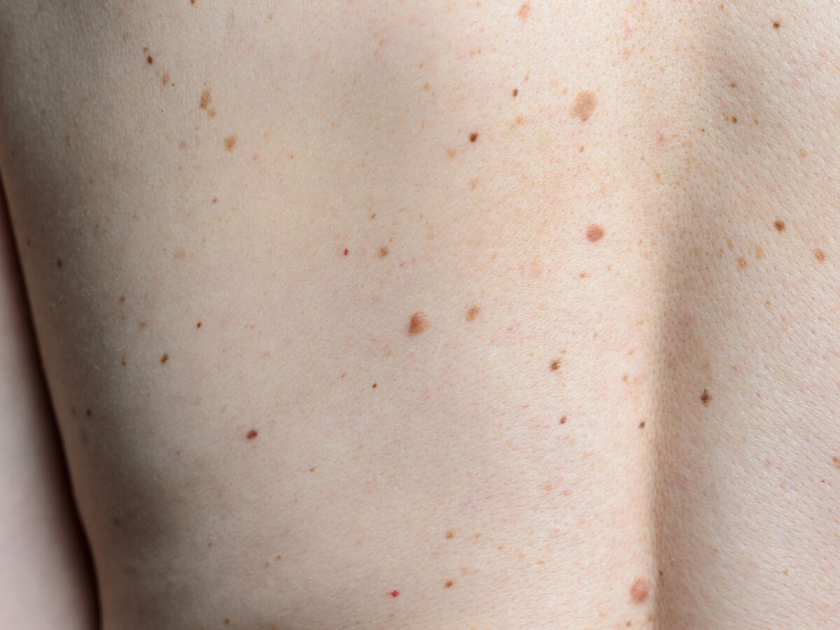 Cancer de la peau : une mannequin alerte sur une "tache de rousseur" qui s'est révélée être un mélanome