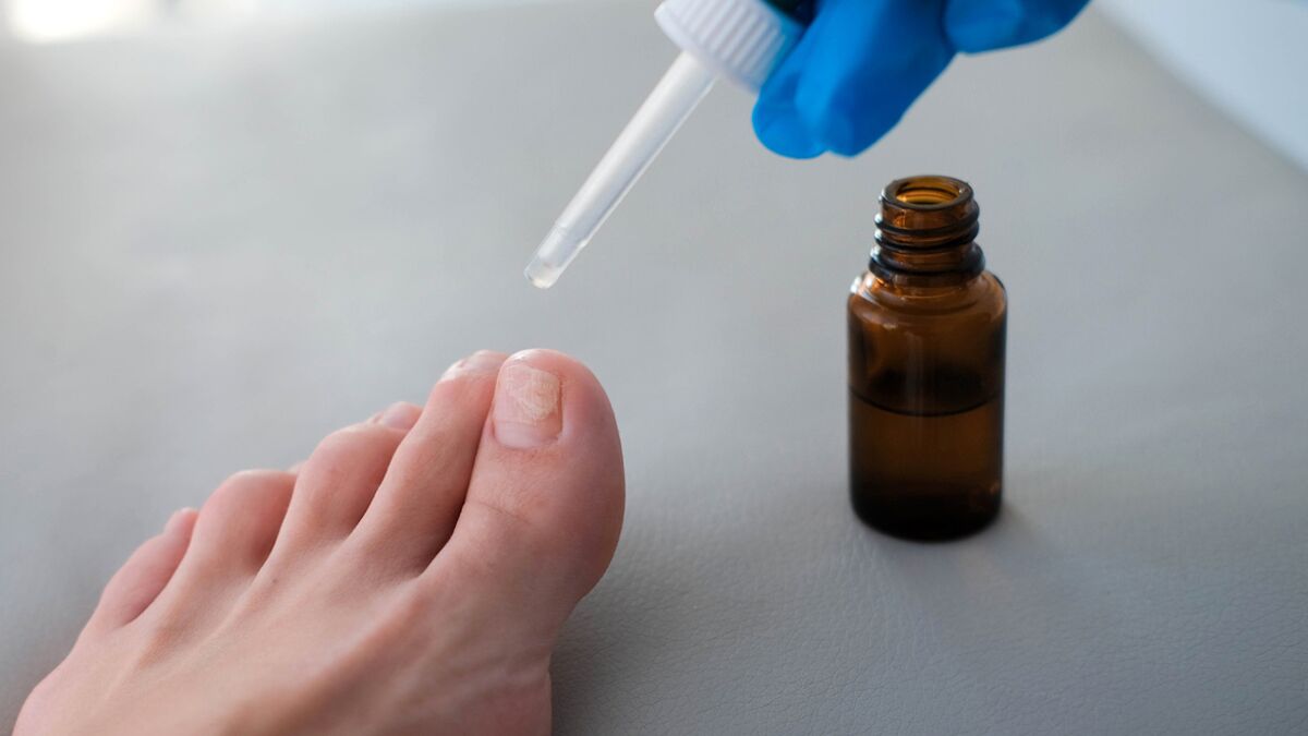 Mycoses des ongles de pied (onychomycose) : 5 erreurs à ne pas faire :  Femme Actuelle Le MAG