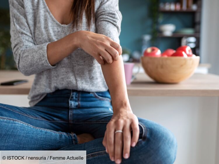 Eczéma : consommer ces aliments en particulier favoriserait les crises ...