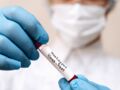 Dépistage de la variole du singe : fonctionnement des tests, remboursement… Ce que l’on sait