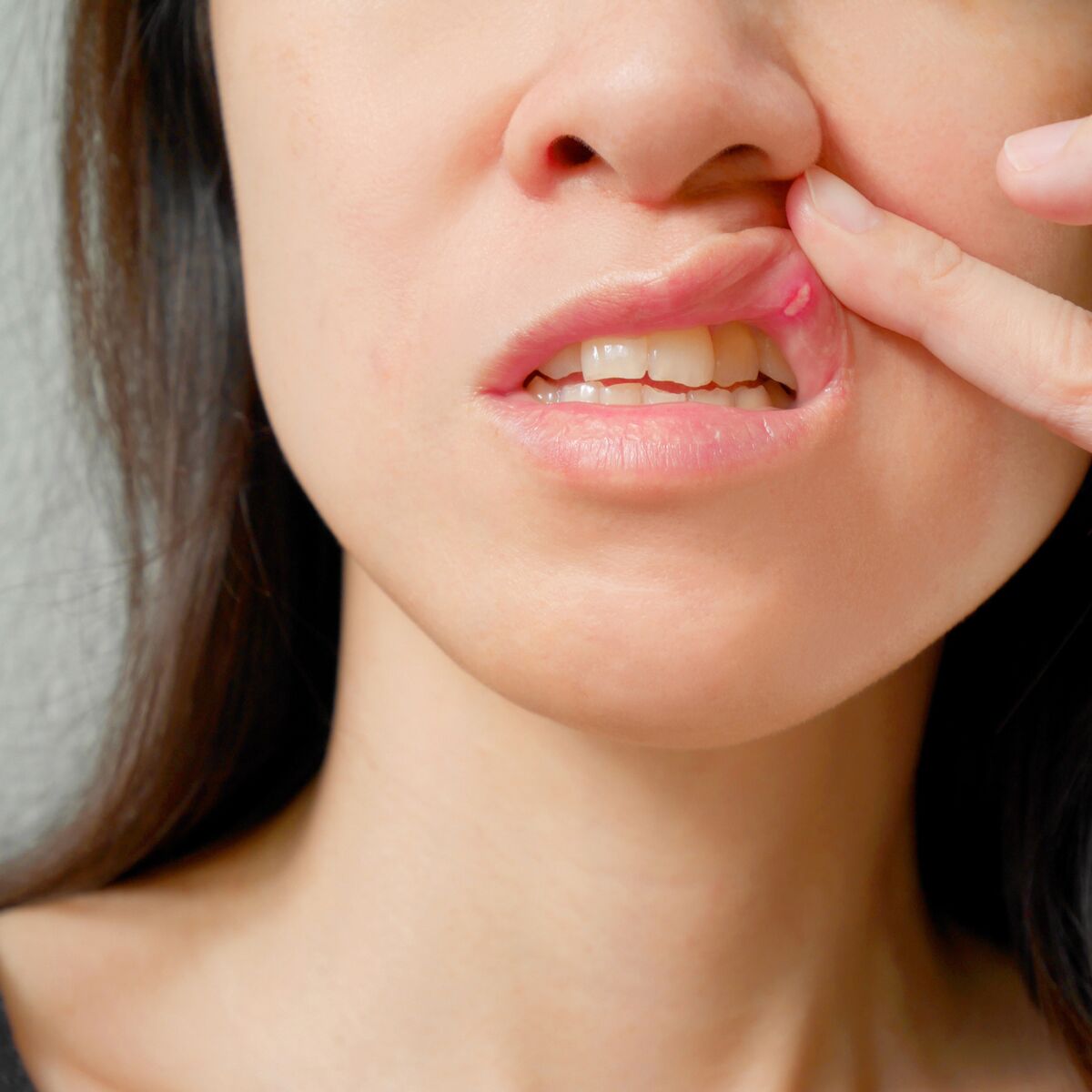 Maladie De Behcet Peut On En Mourir Maladie de Behçet : cause, diagnostic, symptômes, traitement : Femme  Actuelle Le MAG