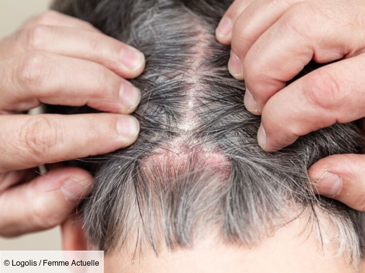 Psoriasis du cuir chevelu : causes, symptômes; traitements et remèdes efficaces