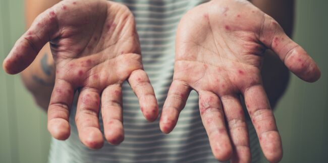 Pied main bouche : peut-on attraper cette maladie à l'âge adulte et quels sont les symptômes ?