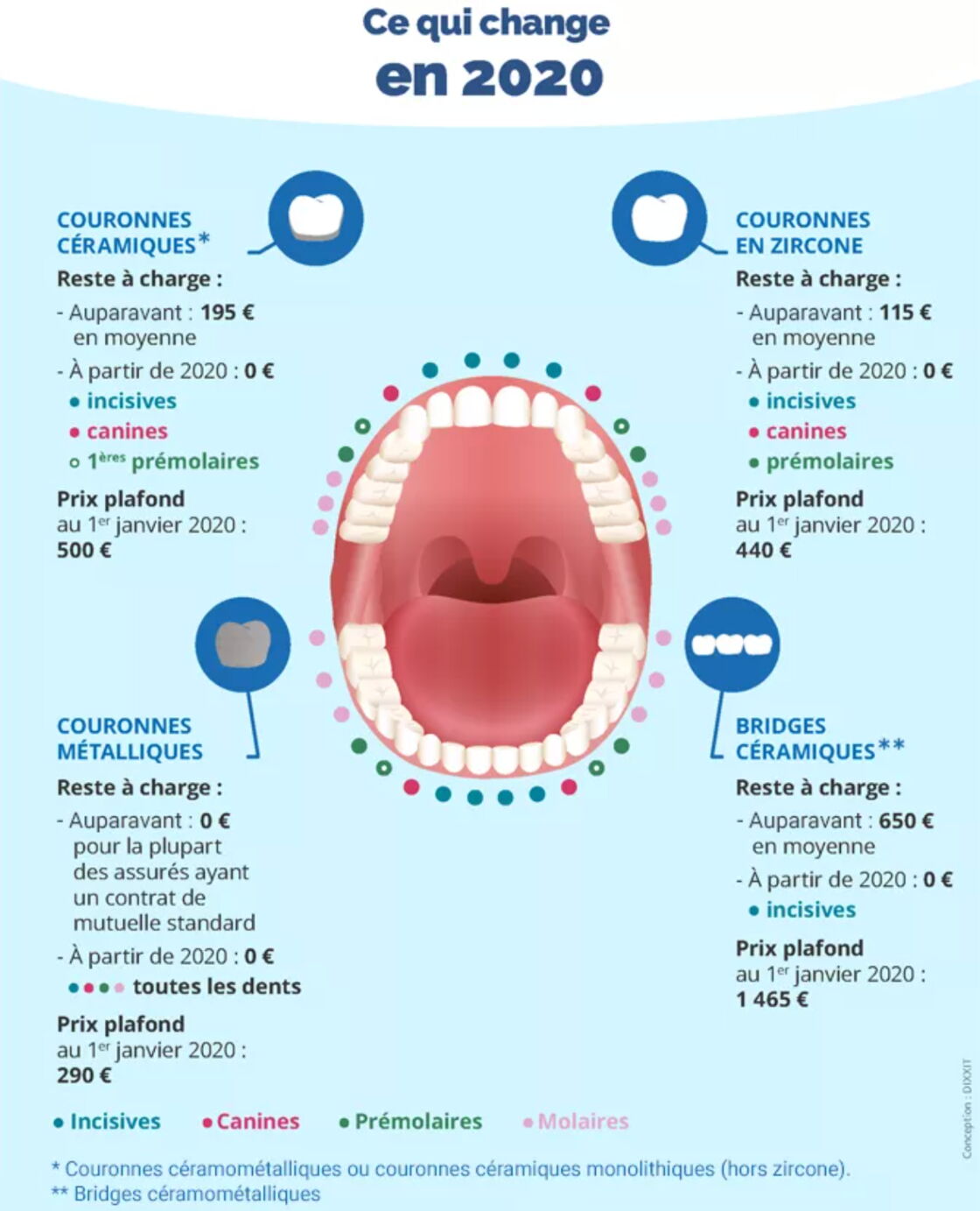 Bridge dentaire pose, durée de vie, prix, remboursement Femme