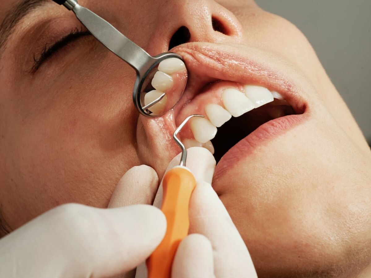 Extraction dentaire : les précautions à prendre avant et après  l'intervention : Femme Actuelle Le MAG