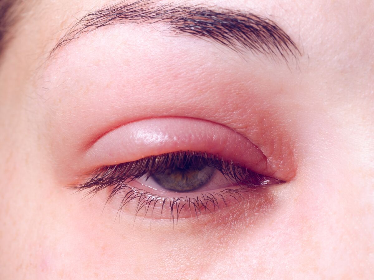 Petit Bouton Blanc Au Ras Des Cils Orgelet : ces facteurs de risques qui peuvent favoriser sa survenue : Femme  Actuelle Le MAG