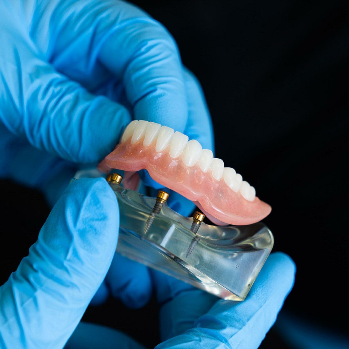 Différents Types de Prothèses Dentaires