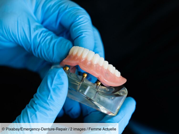 Prothèse dentaire (fixe, amovible) : différents types, pose, prix, remboursement