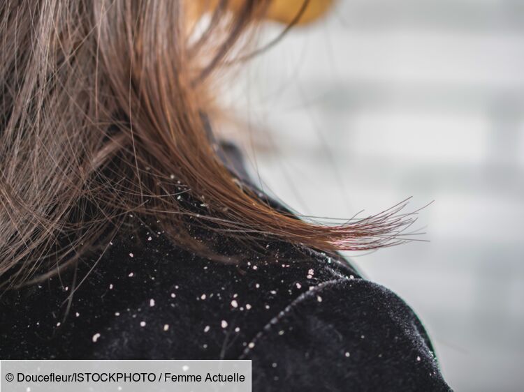 Comment enlever les pellicules ? Les conseils d'une dermatologue