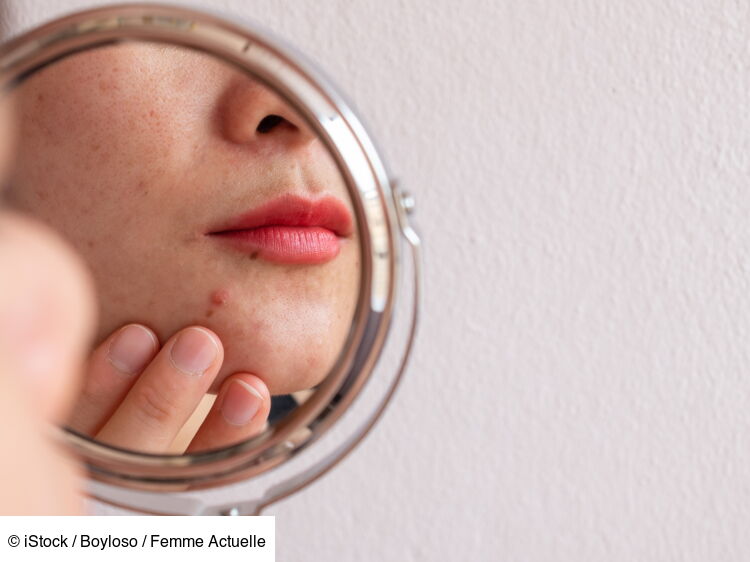 Acné à la ménopause ces zones où elle apparaît le plus souvent, selon