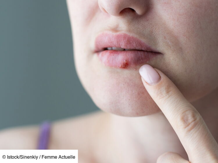 Cancer de la lèvre symptômes, diagnostic, traitements Femme Actuelle Le MAG