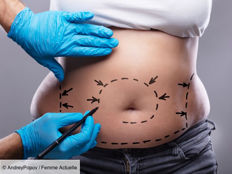 Abdominoplastie : les cas où cette chirurgie du ventre est prise en charge par la sécurité sociale
