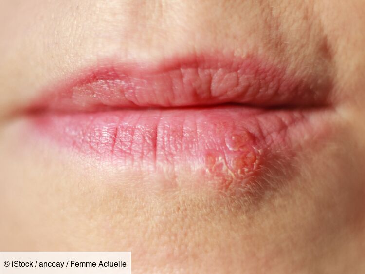 Cancer de la lèvre : signes précoces, causes, diagnostic et traitements