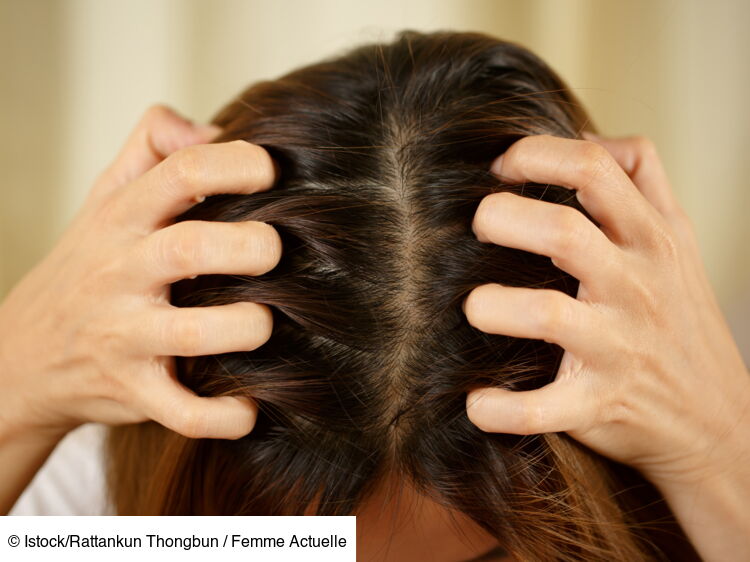 Irritation du cuir chevelu causes, durée, comment la soulager