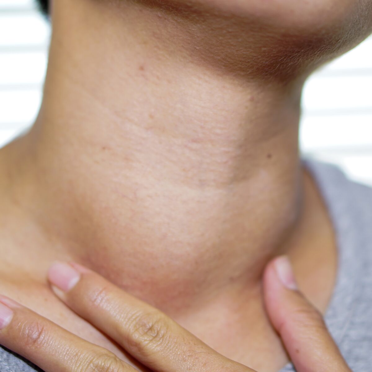 Goitre thyroïdien : causes, symptômes et traitements pour le faire ...