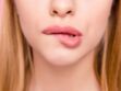 Dermatillomanie : comment arrêter de triturer ses lèvres 