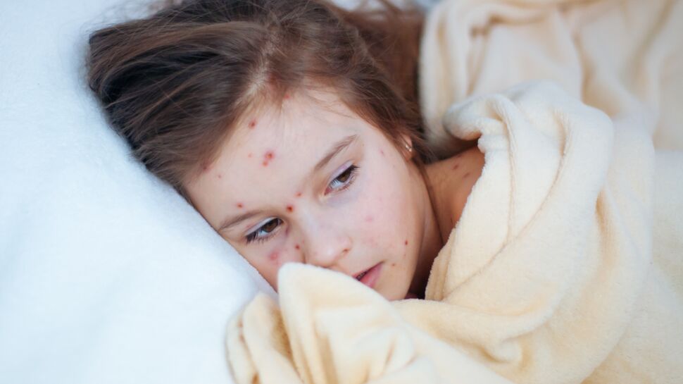 La varicelle : symptômes, traitement et prévention