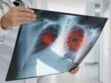 Scintigraphie pulmonaire : intérêts, déroulement et prise en charge