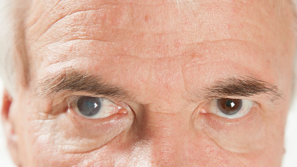 Cataracte : définition, causes, symptômes, opération, traitements