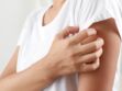 Dermatite atopique : définition, symptômes et traitements