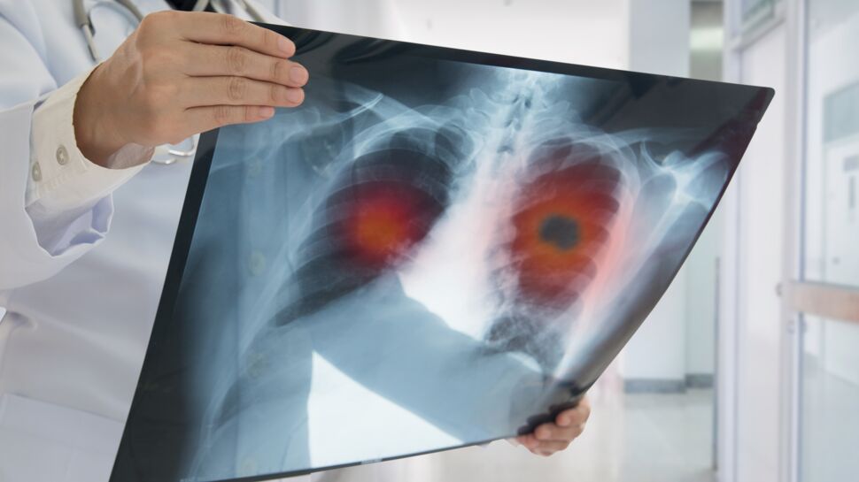 Cancer du poumon : causes, symptômes, traitements et guérison