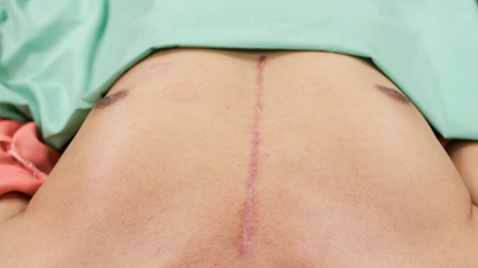 Sternotomie : définition, causes, cicatrice et convalescence post-opératoire