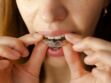 Orthodontie : les professionnels alertent sur les gouttières d'alignement dentaire sans suivi