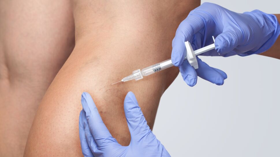 Sclérothérapie : contre-indications, remboursement, effets secondaires du traitement des varicosités par injection