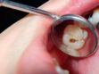 Carie dentaire : symptômes, causes, traitements et comment l’éviter