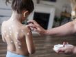Épidémie de varicelle : les bons réflexes à adopter si votre enfant l'a attrapée