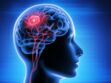 Gliomes cérébraux : définition, symptômes, traitement de ces tumeurs du cerveau