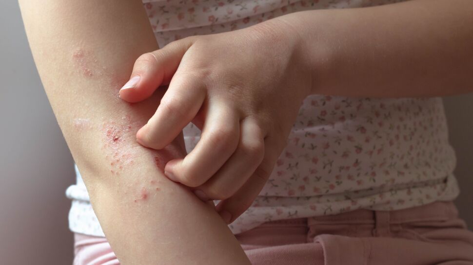 Atopie (terrain allergique) : causes, symptômes, risques, prévention, traitements