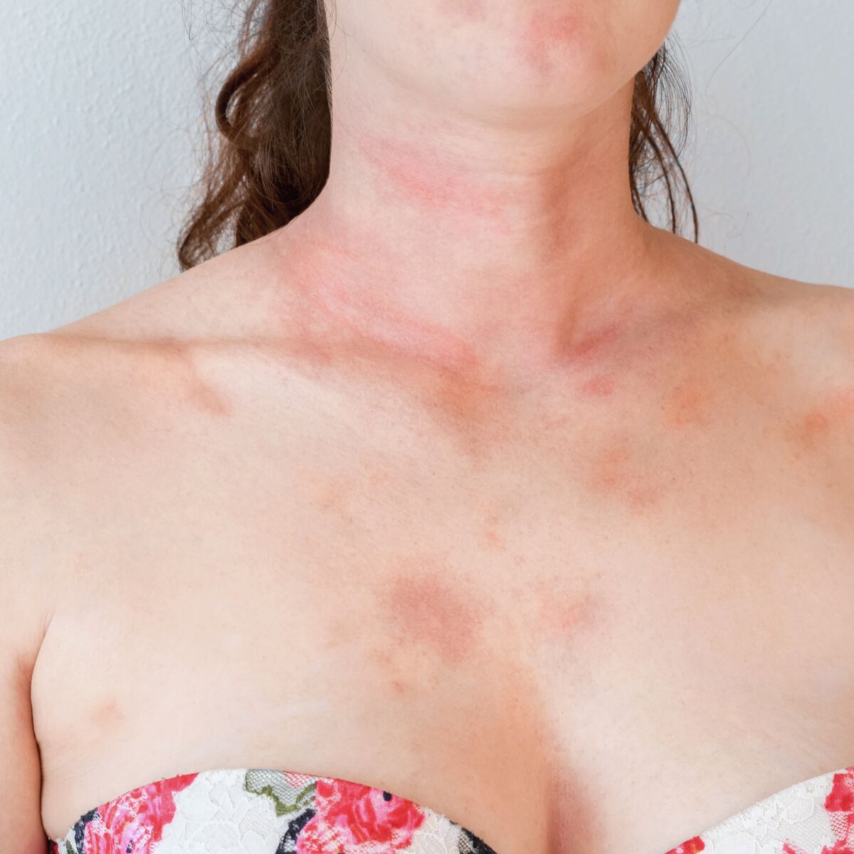 Allergies au soleil : quels sont les symptômes, comment réagir et ...