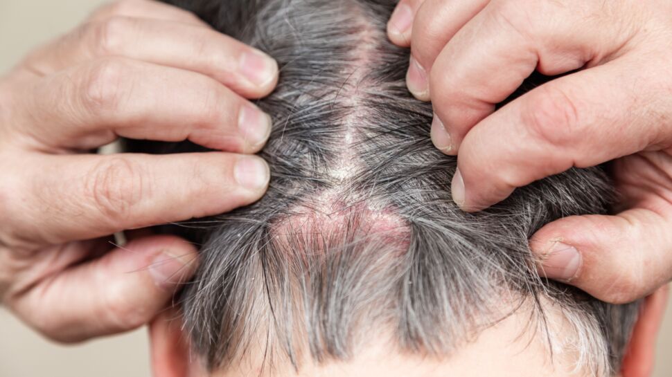 Psoriasis du cuir chevelu : causes, symptômes, traitements et ...