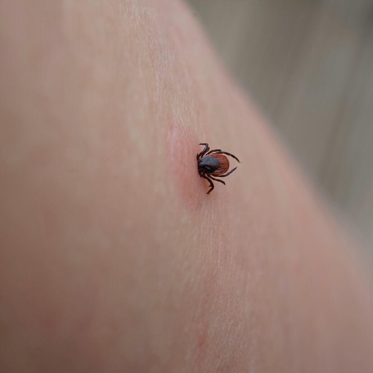 Maladie de Lyme : les symptômes à surveiller après une morsure de ...