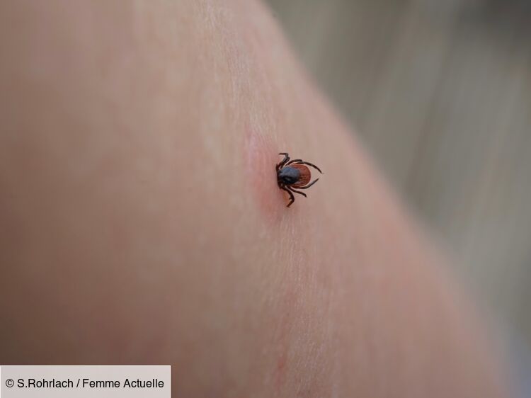 Maladie de Lyme : les symptômes à surveiller après une morsure de ...