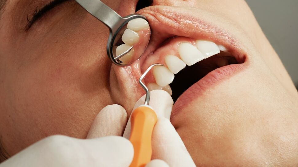 Alvéolite dentaire : définition, causes, symptômes, traitement