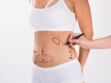 Abdominoplastie : en quoi consiste cette chirurgie esthétique pour avoir un ventre plus plat ?