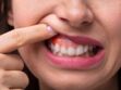 Parodontite : les différents traitements contre le déchaussement des dents