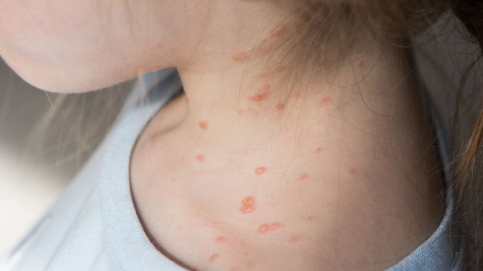 Durée varicelle : quelle est la période de contagion de cette maladie ?