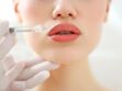 Médecine esthétique : les dégâts des injections dans les lèvres réalisées par de faux praticiens