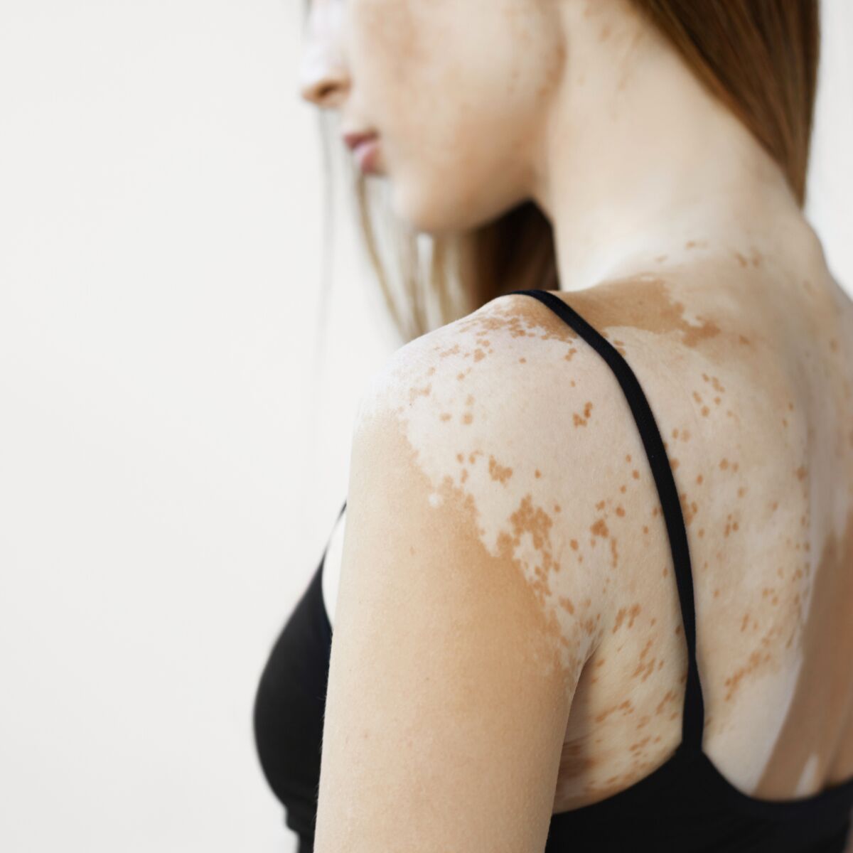 Vitiligo : pour la première fois, une crème efficace pour repigmenter ...