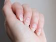 Leuconychie (taches blanches sur l'ongle) : causes et soins
