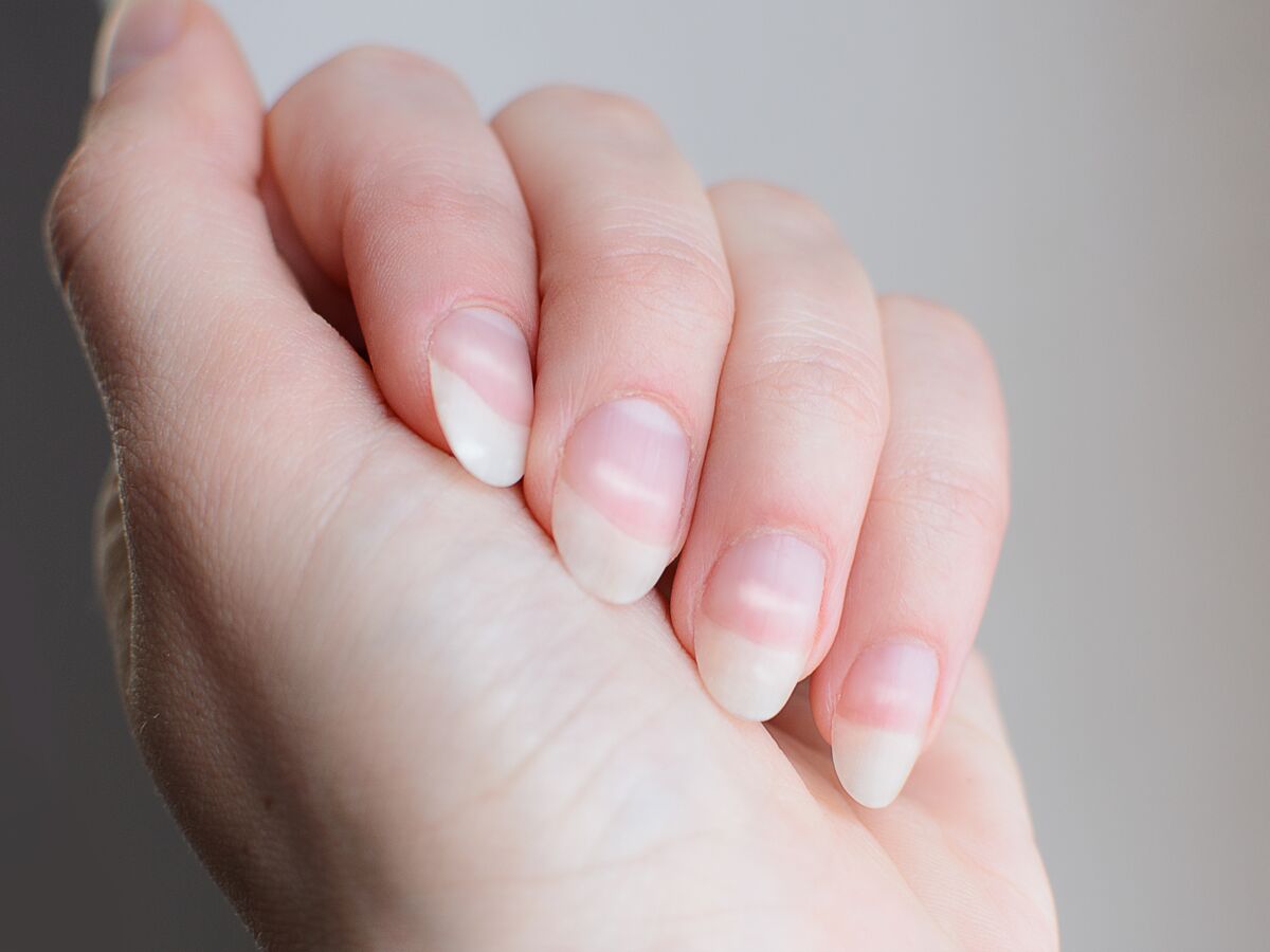 Leuconychie (taches blanches sur l'ongle) : causes et soins ...