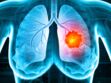 Traitements du cancer du poumon : comment se soigne-t-il selon le stade ?
