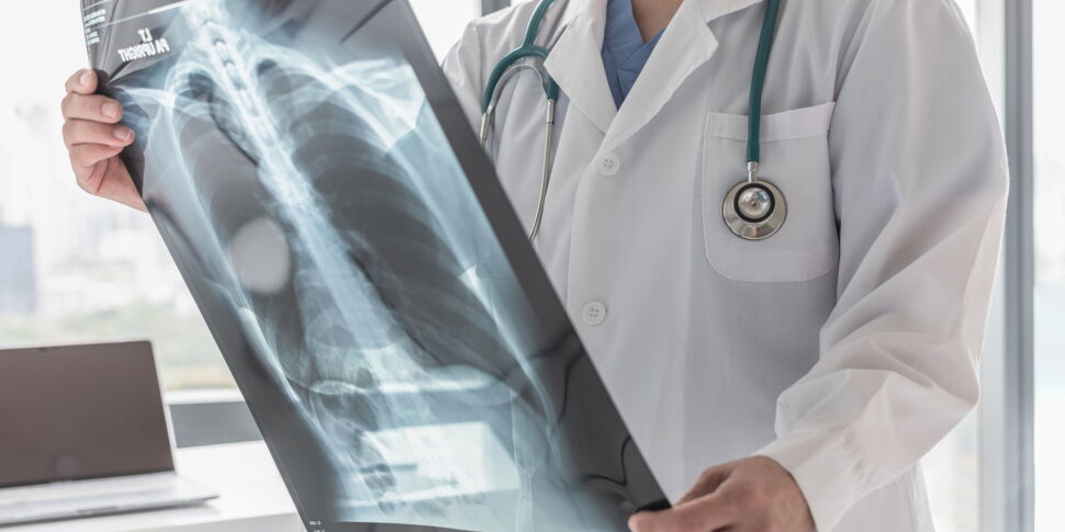 Cancer du poumon de la femme : chiffres, causes, symptômes : Femme